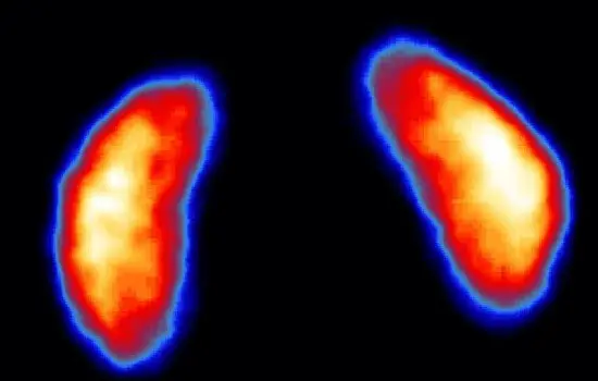 Нефросцинтиграфия