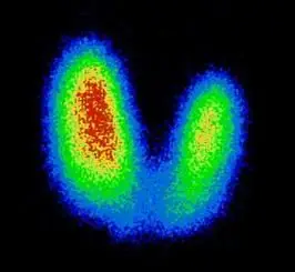 Радиоизотопная сцинтиграфия